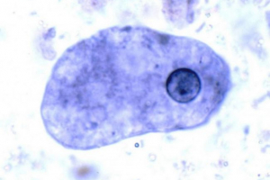Dysenteric ameba - jednostavan slučaj ozbiljne bolesti